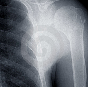 Shoulder x ray mercedes benz #1